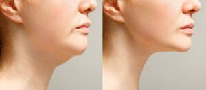 Facelift with neck lift in Troy and Novi, MI