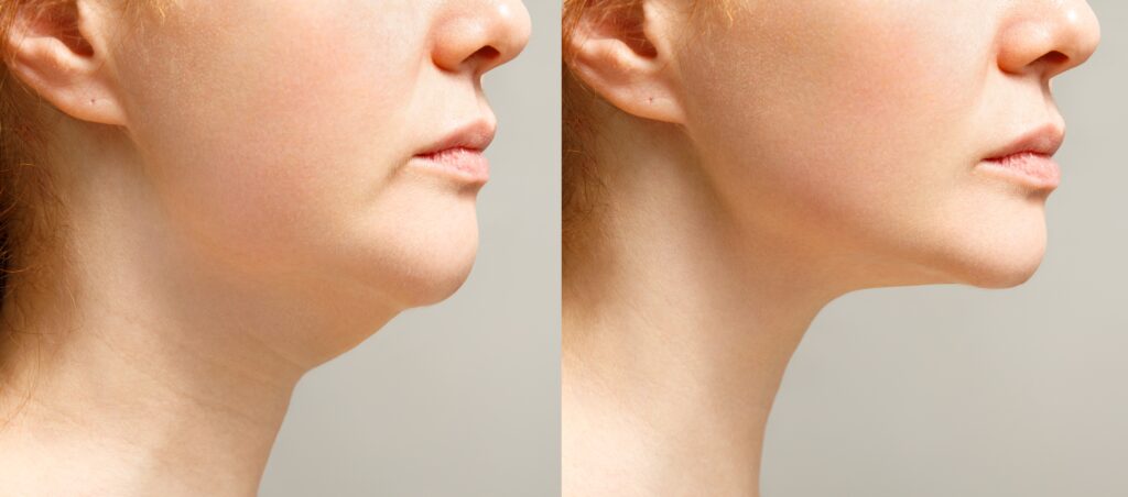 Facelift and neck lift in Troy and Novi, MI