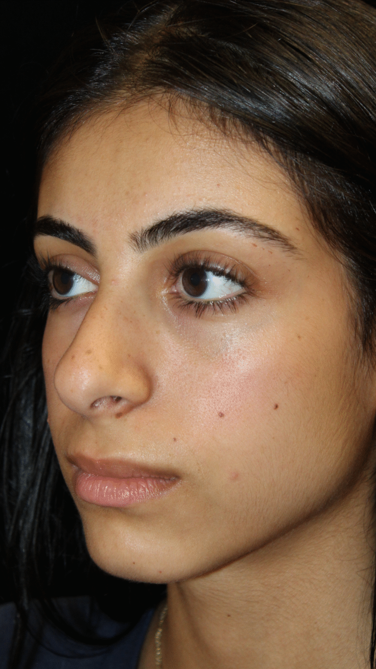 Before Image: Preservation Rhinoplasty - left-front-oblique