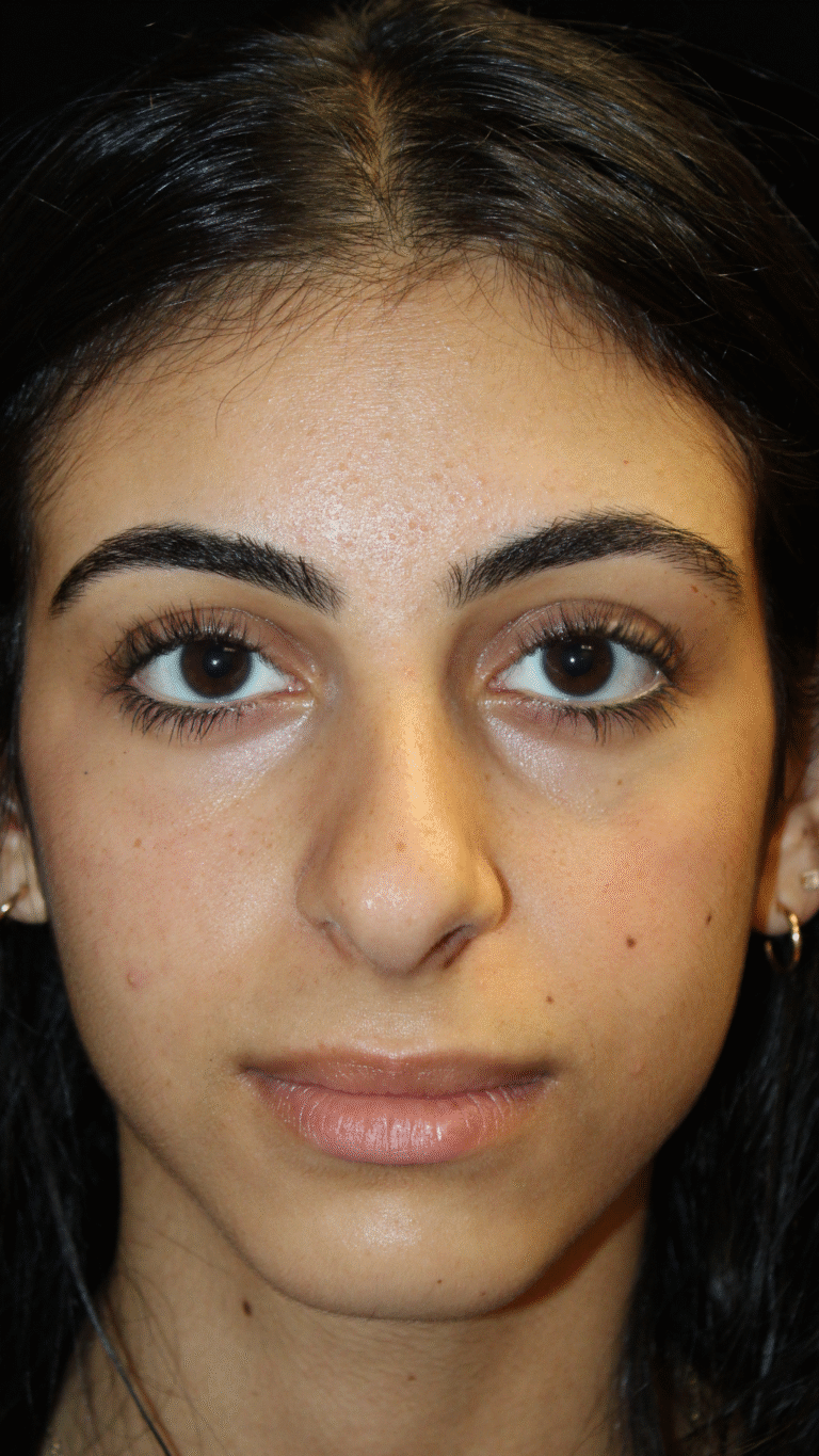 Before Image: Preservation Rhinoplasty - front