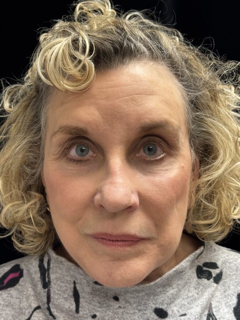 After Image: Facelift - front