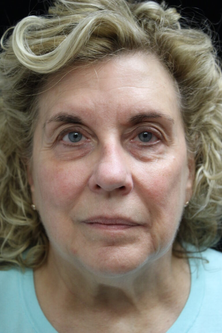 Before Image: Facelift - front