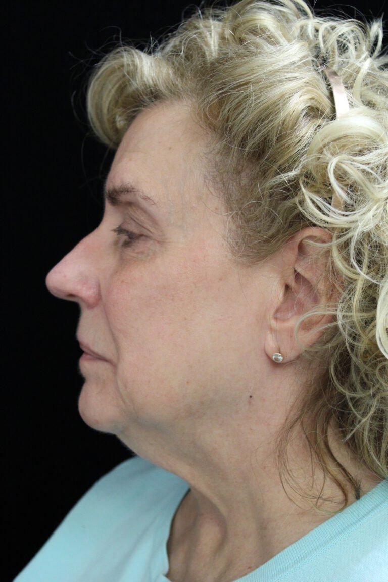 Before Image: Facelift - left-side
