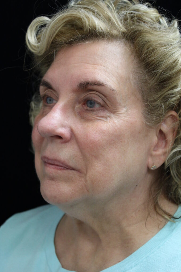 Before Image: Facelift - left-front-oblique