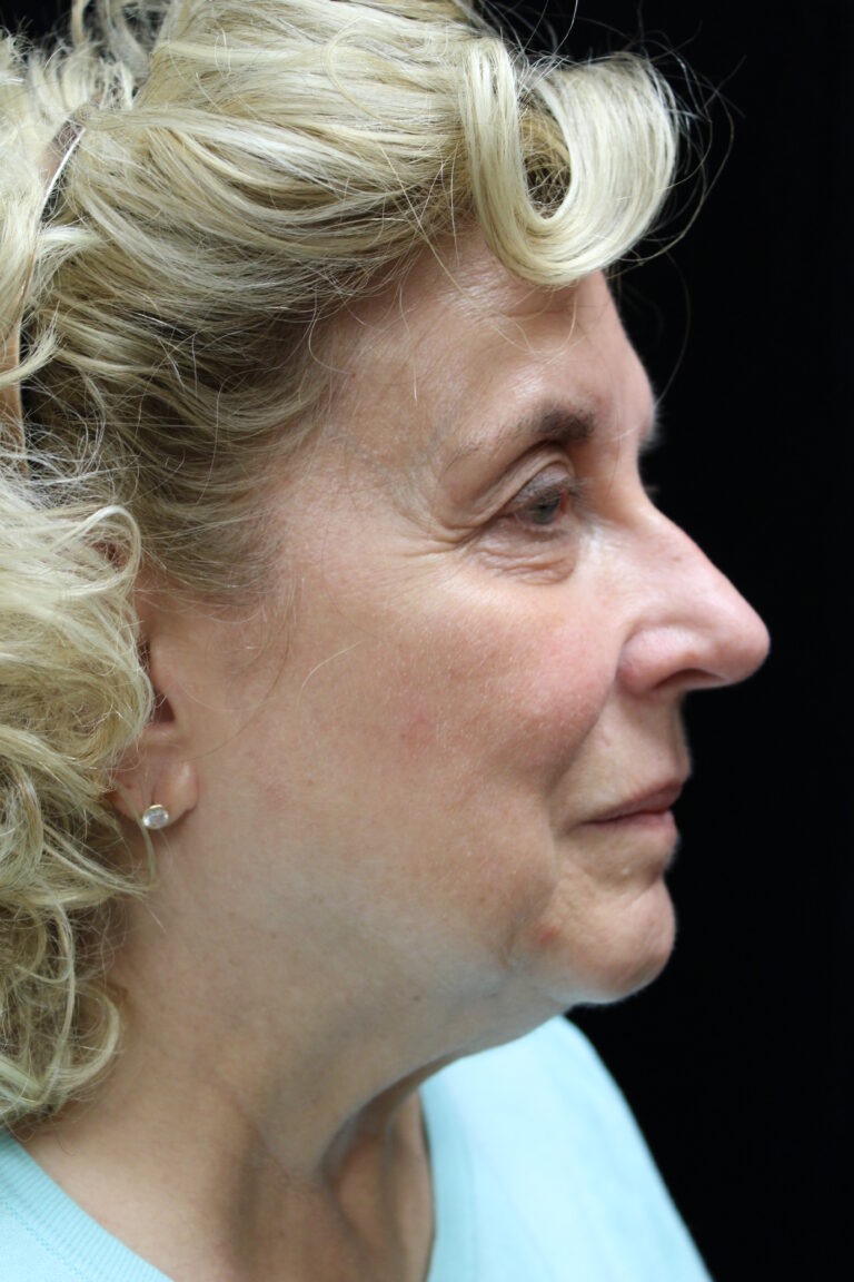 Before Image: Facelift - 
