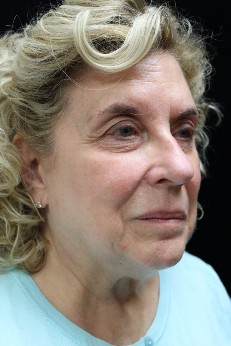 Before Image: Facelift - right-front-oblique