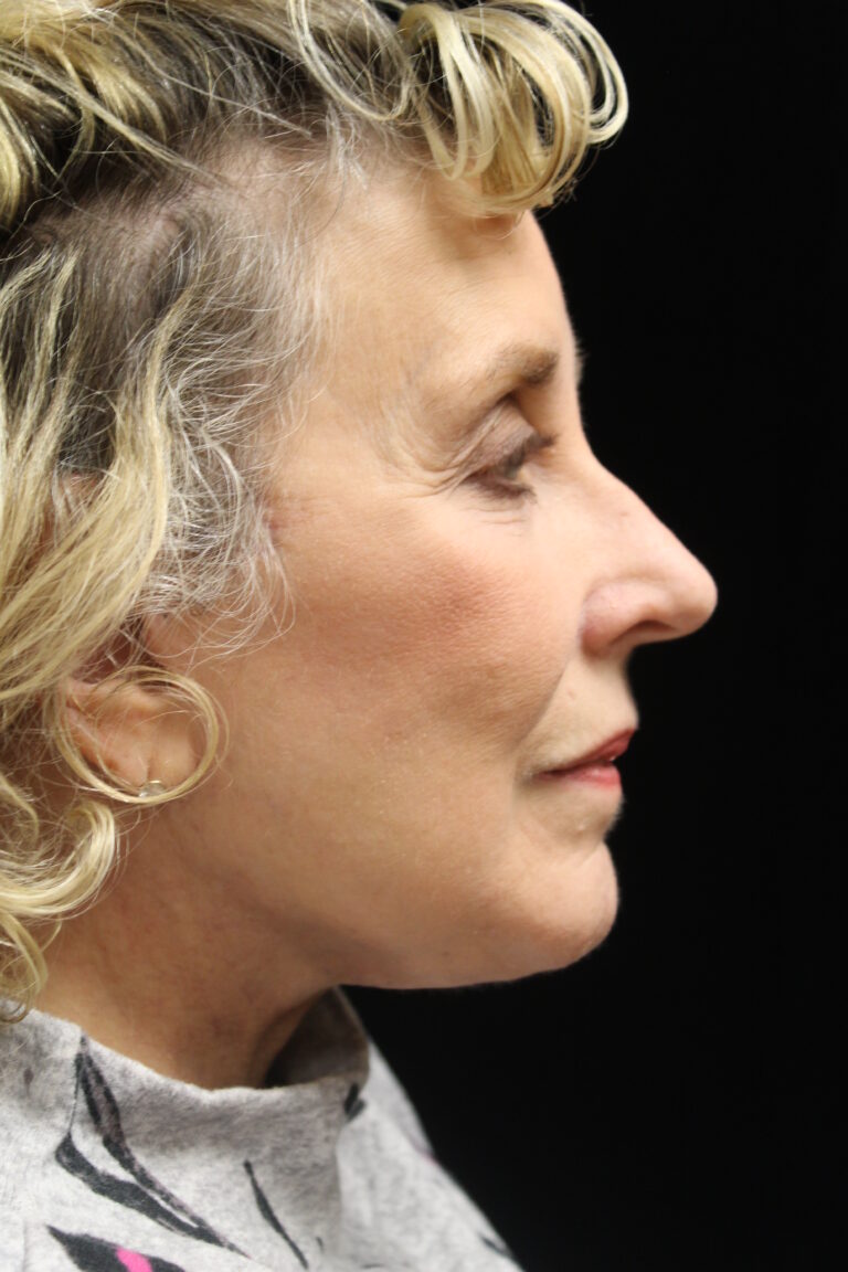 After Image: Facelift - 