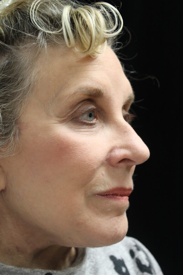 After Image: Facelift - right-front-oblique