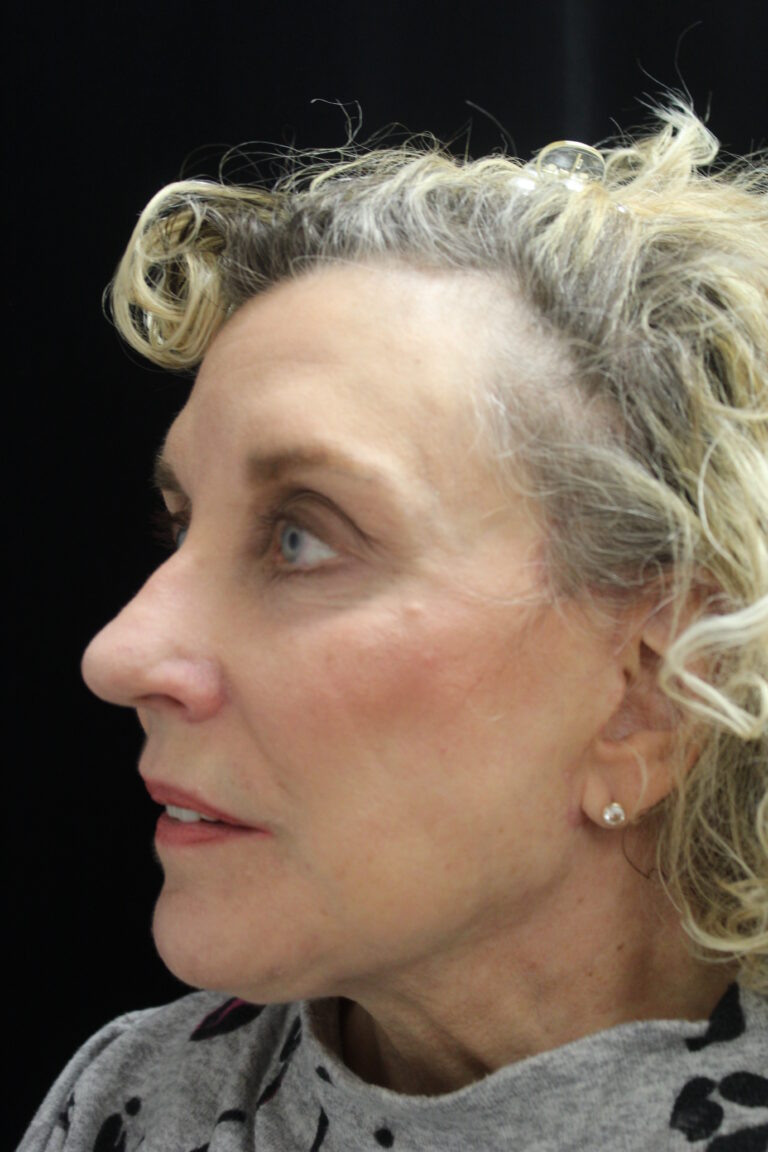After Image: Facelift - left-front-oblique