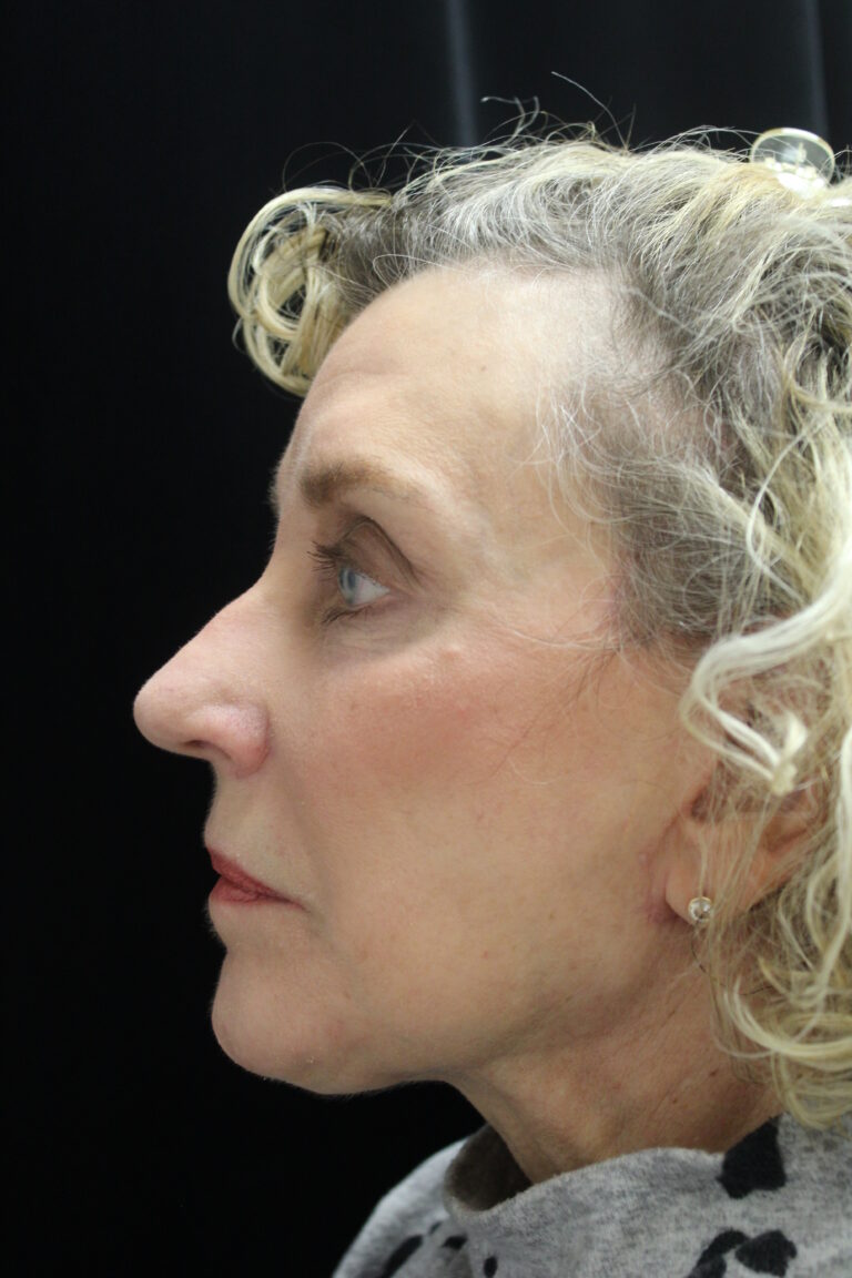 After Image: Facelift - left-side