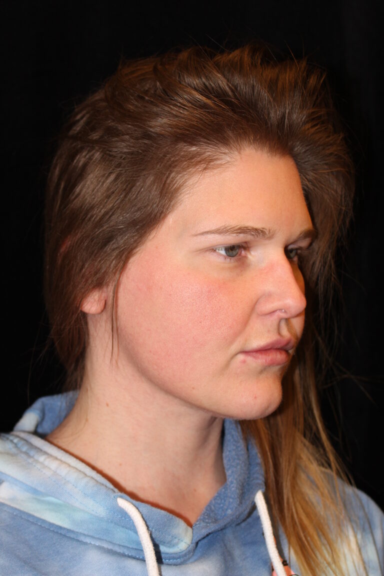 After Image: Neck Lift - front