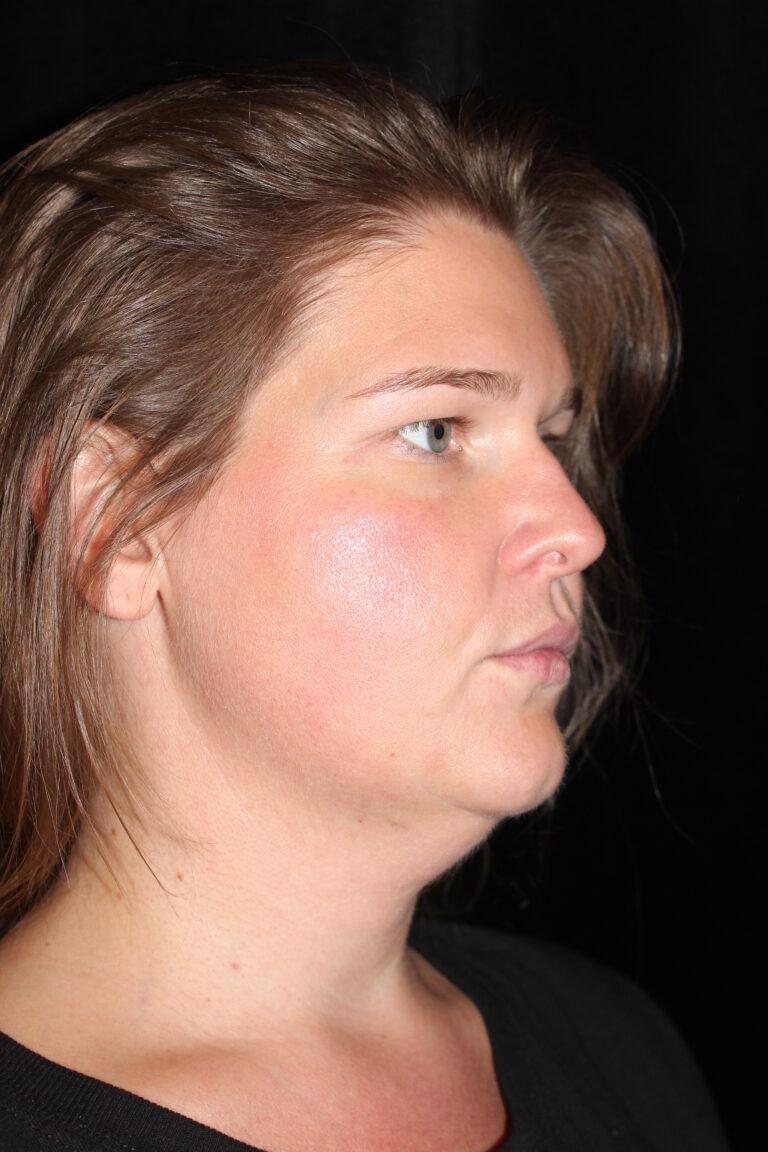Before Image: Neck Lift - front