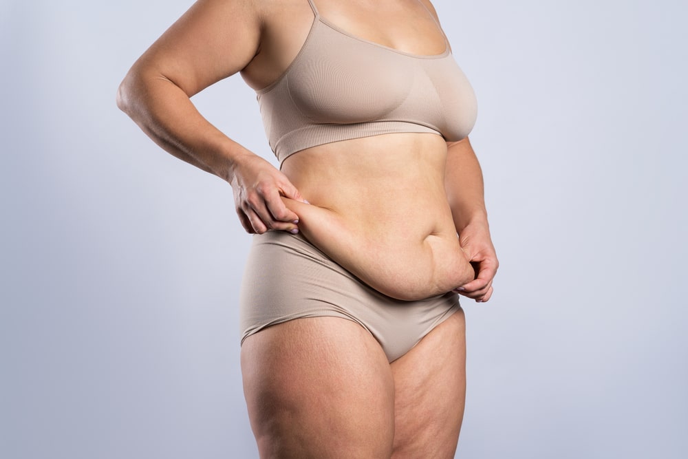 Woman, considering a tummy tuck or liposuction, clutches extra belly skin and fat after losing weight