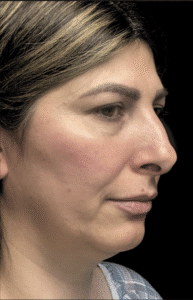 Before Image: Rhinoplasty