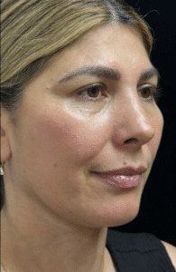 After Image: Rhinoplasty