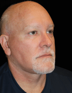After Image: Facelift