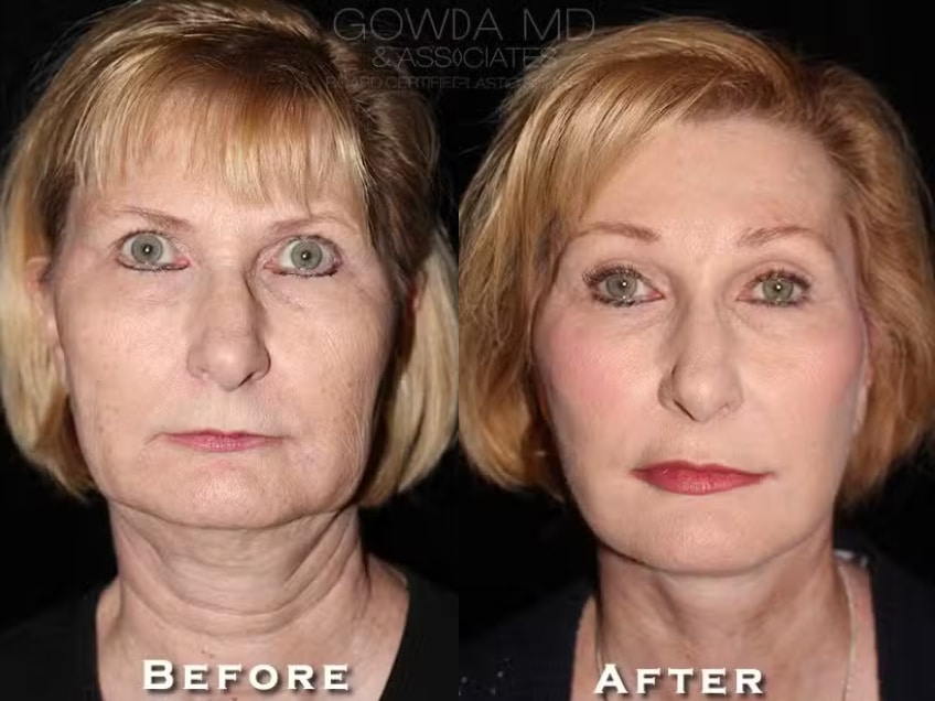 Facelift