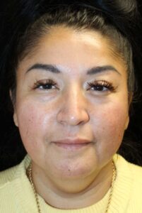 Before Image: Deep Plane Facelift & Neck Lift