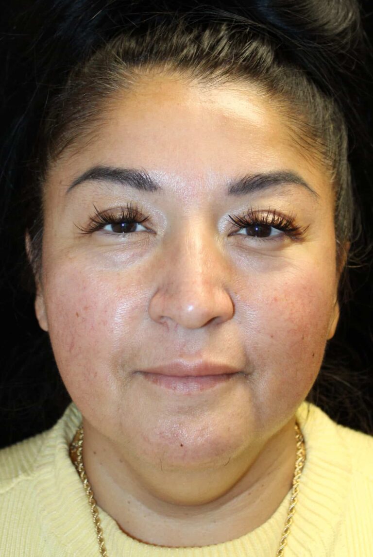 Before Image: Deep Plane Facelift & Neck Lift - front