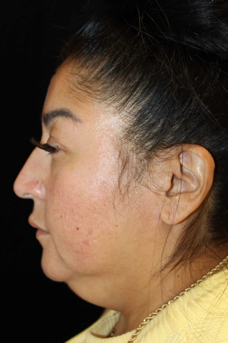 Before Image: Deep Plane Facelift & Neck Lift - left-side