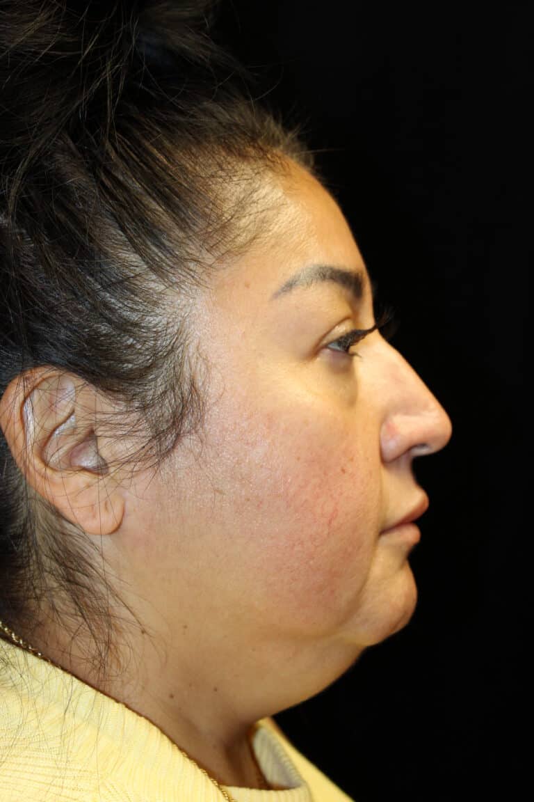 Before Image: Deep Plane Facelift & Neck Lift - right-side