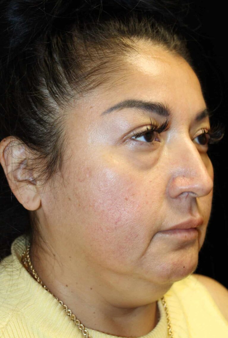 Before Image: Deep Plane Facelift & Neck Lift - right-front-oblique