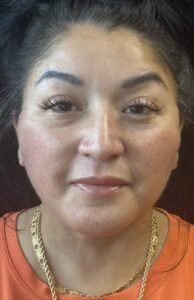 After Image: Deep Plane Facelift & Neck Lift