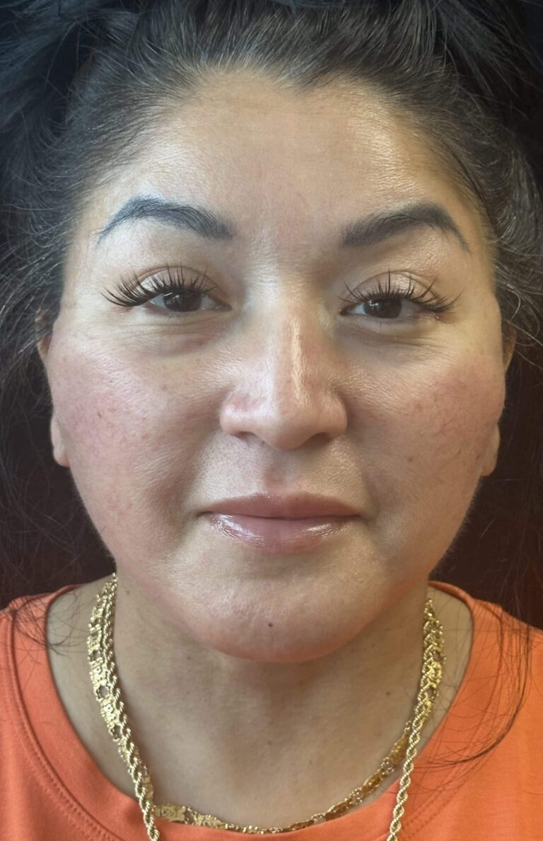 After Image: Deep Plane Facelift & Neck Lift - front