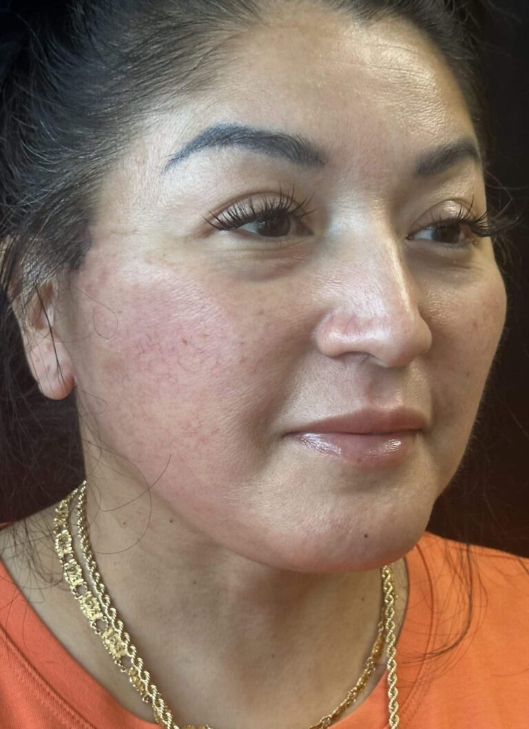 After Image: Deep Plane Facelift & Neck Lift - right-front-oblique