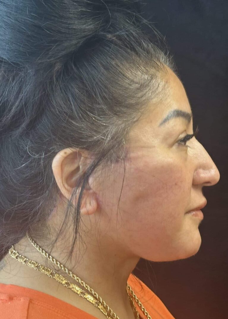 After Image: Deep Plane Facelift & Neck Lift - right-side