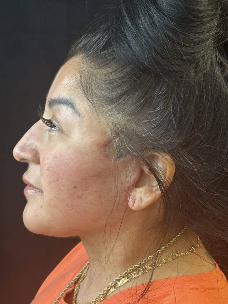 After Image: Deep Plane Facelift & Neck Lift - left-side