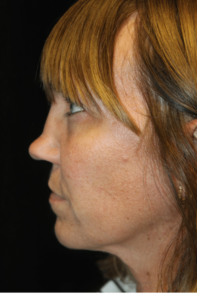 Before Image: Septoplasty with Spreader Grafts -