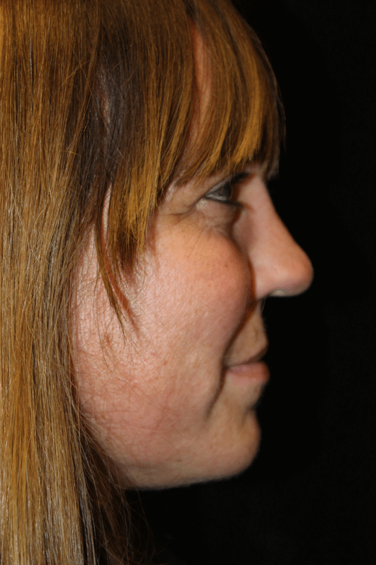 After Image: Septoplasty with Spreader Grafts - right-front-oblique