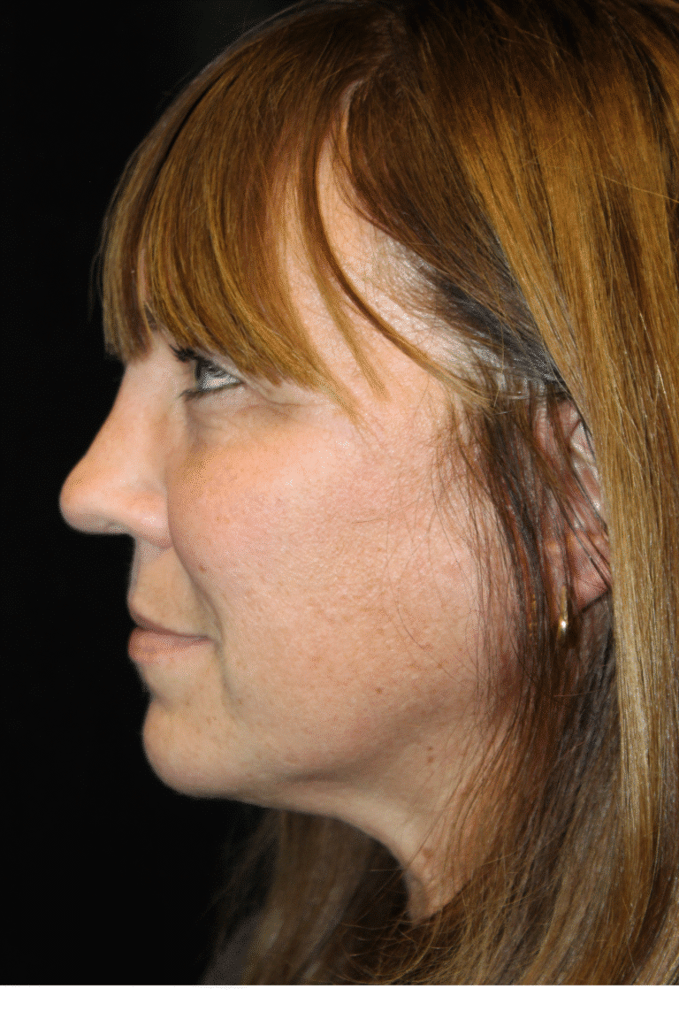 After Image: Septoplasty with Spreader Grafts -