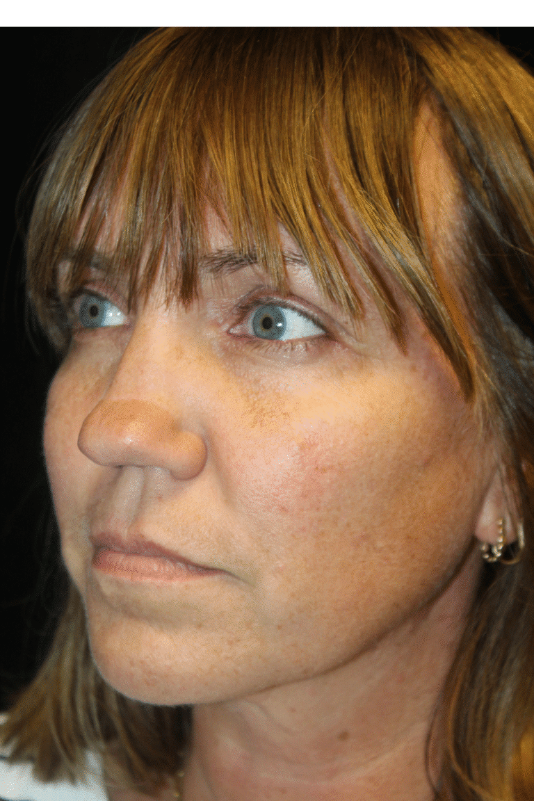 Before Image: Septoplasty with Spreader Grafts - left-front-oblique