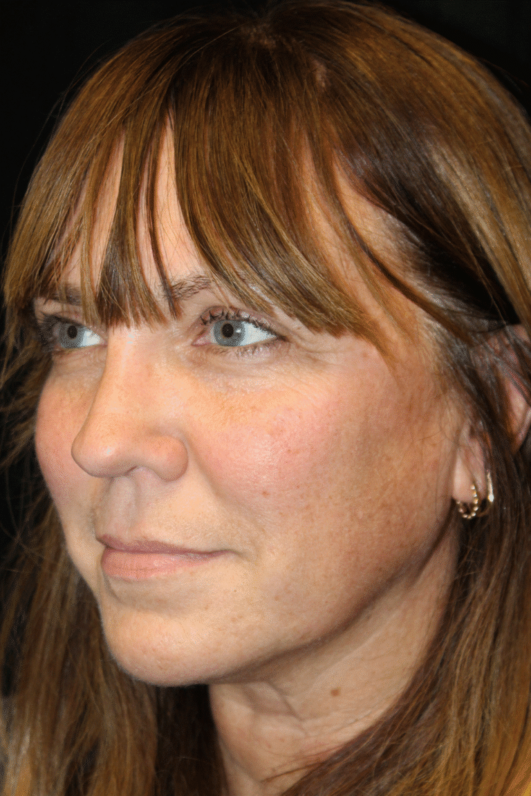 After Image: Septoplasty with Spreader Grafts - left-front-oblique