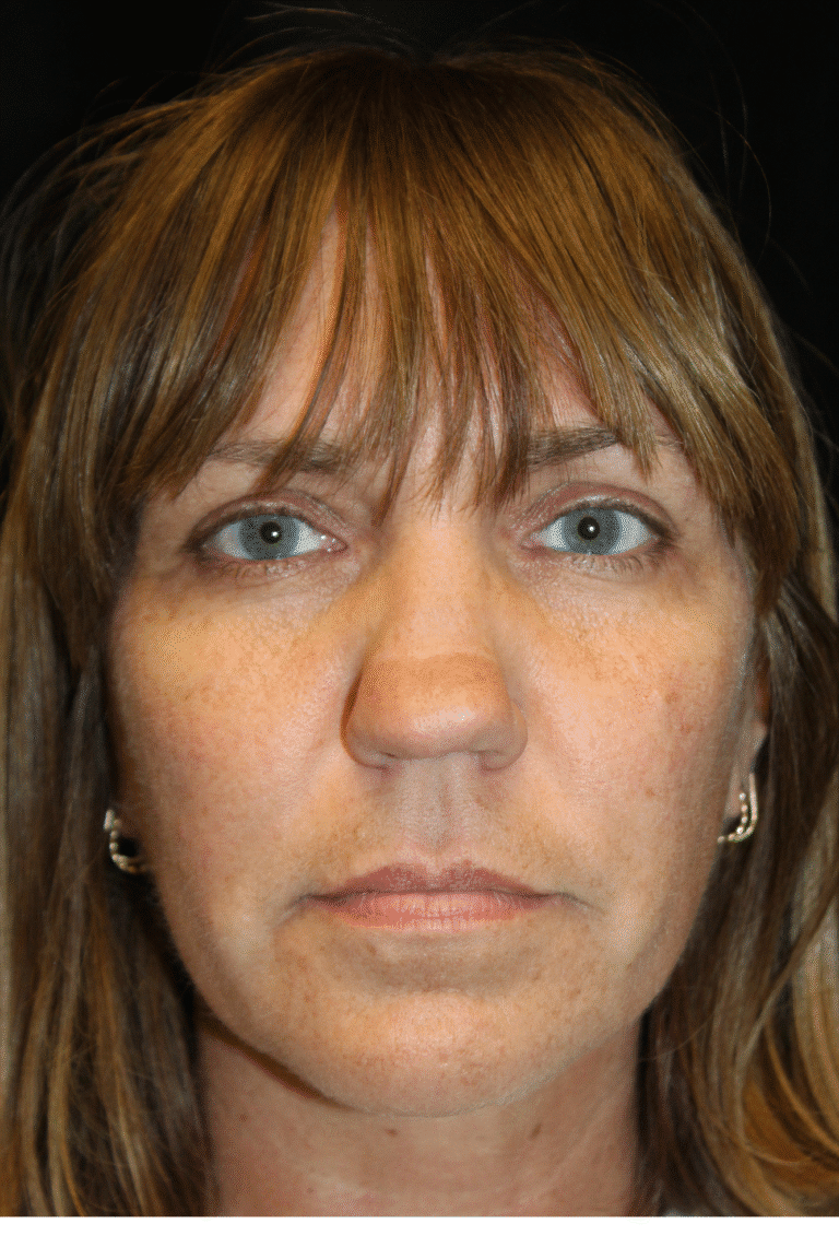 Before Image: Septoplasty with Spreader Grafts - front