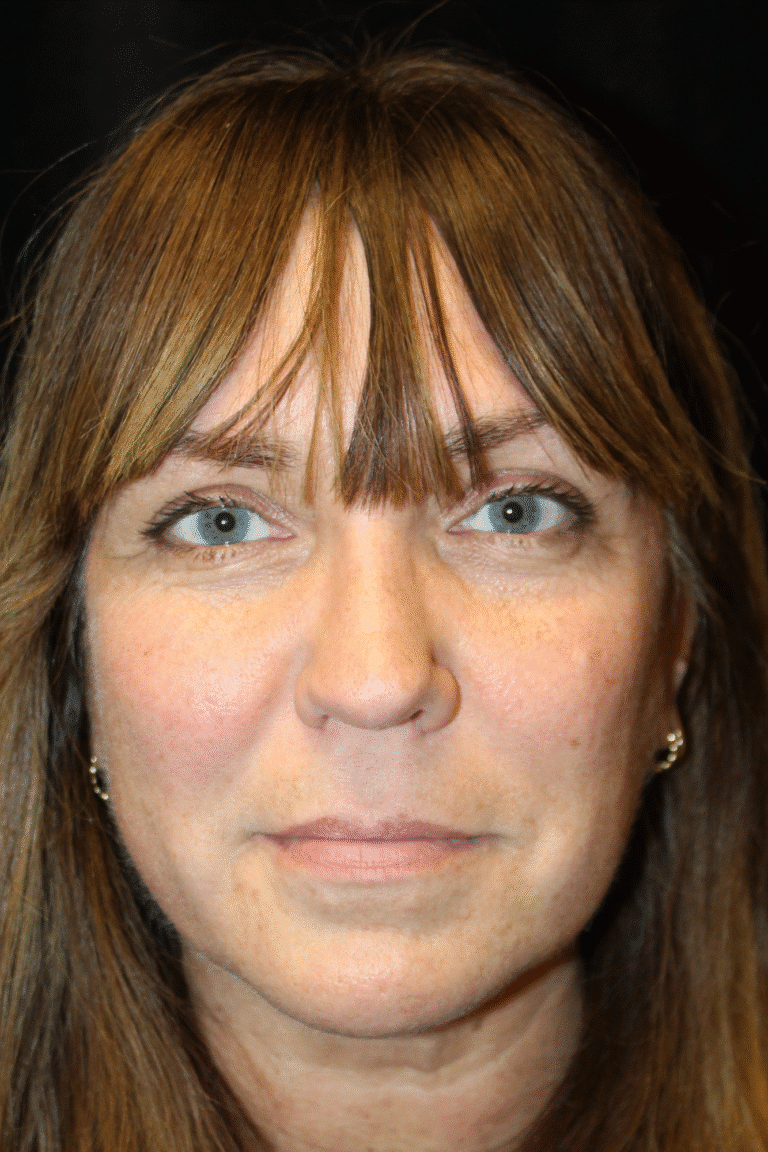 After Image: Septoplasty with Spreader Grafts - front