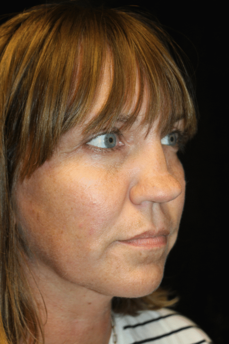 Before Image: Septoplasty with Spreader Grafts - right-front-oblique