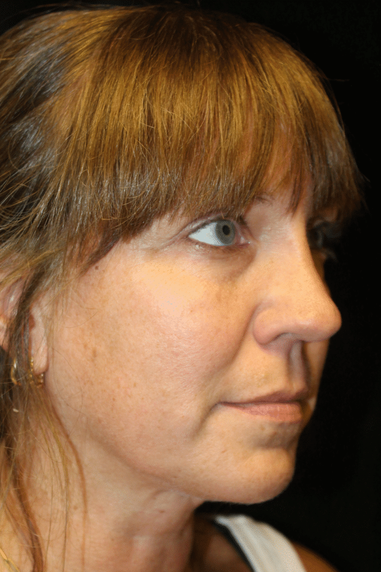 After Image: Septoplasty with Spreader Grafts - right-front-oblique