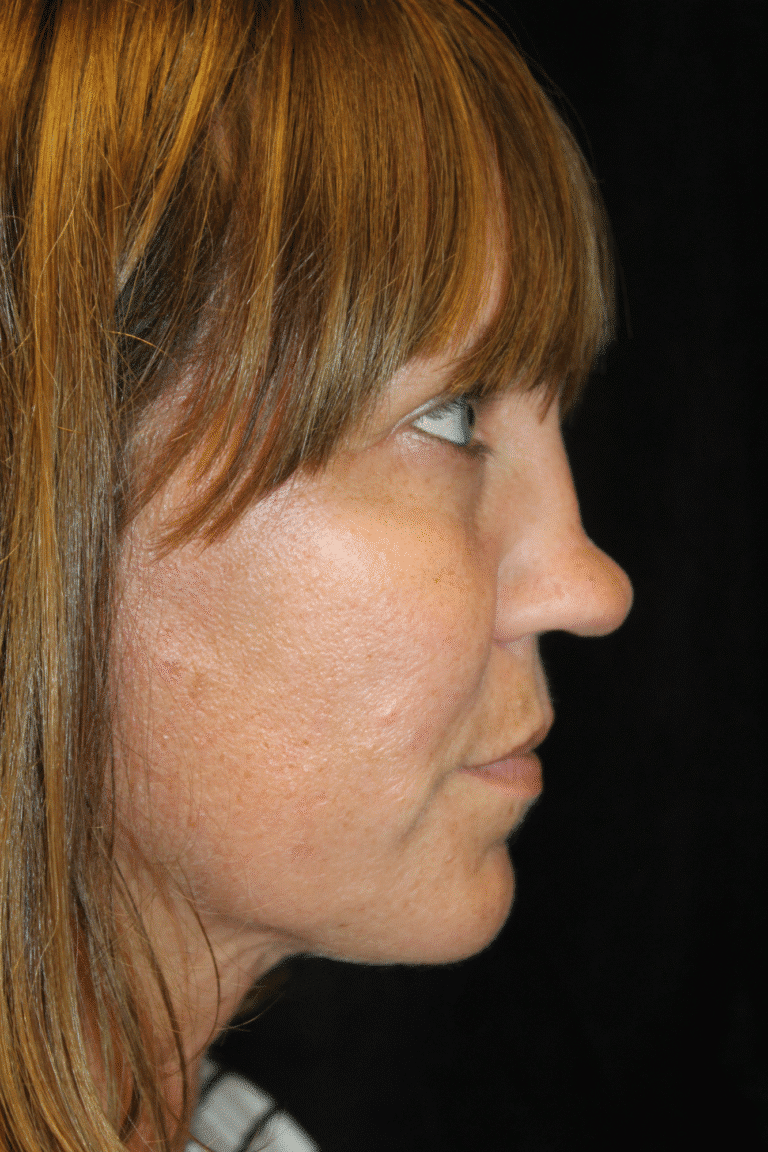 Before Image: Septoplasty with Spreader Grafts - right-front-oblique