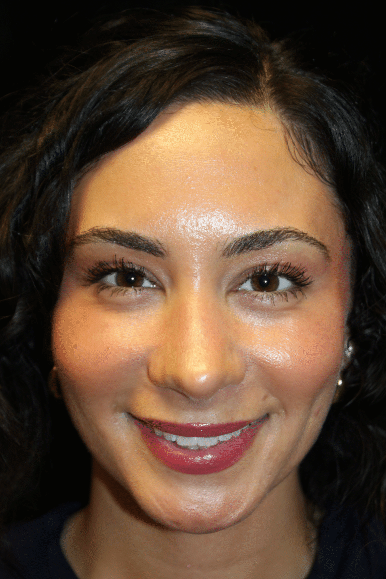 After Image: Preservation Rhinoplasty - front