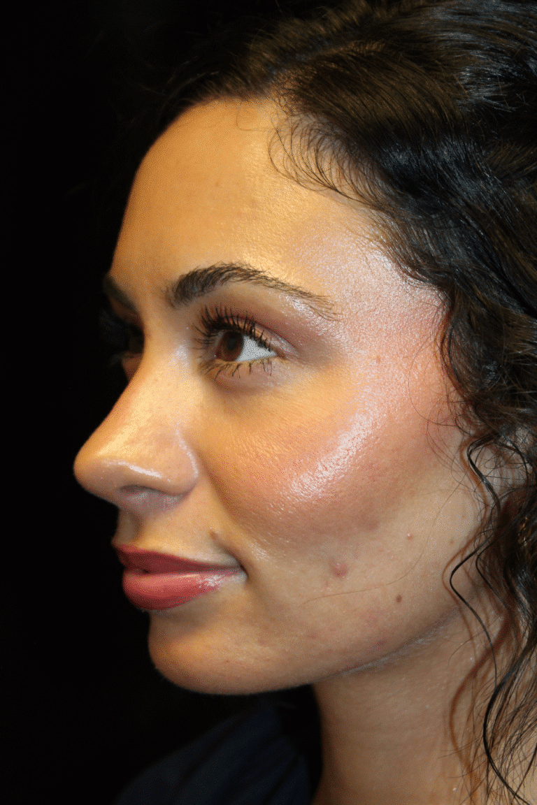 After Image: Preservation Rhinoplasty - left-front-oblique