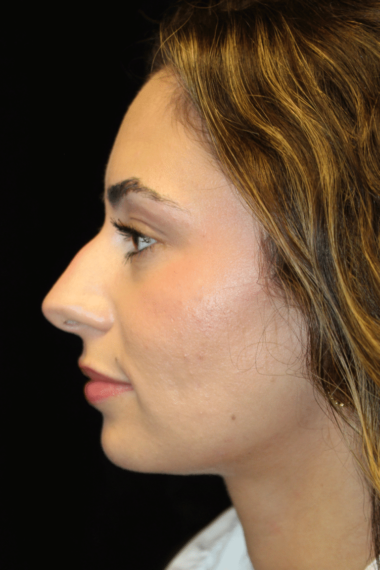 Before Image: Preservation Rhinoplasty - left-side