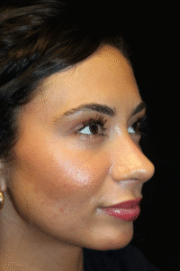 After Image: Preservation Rhinoplasty