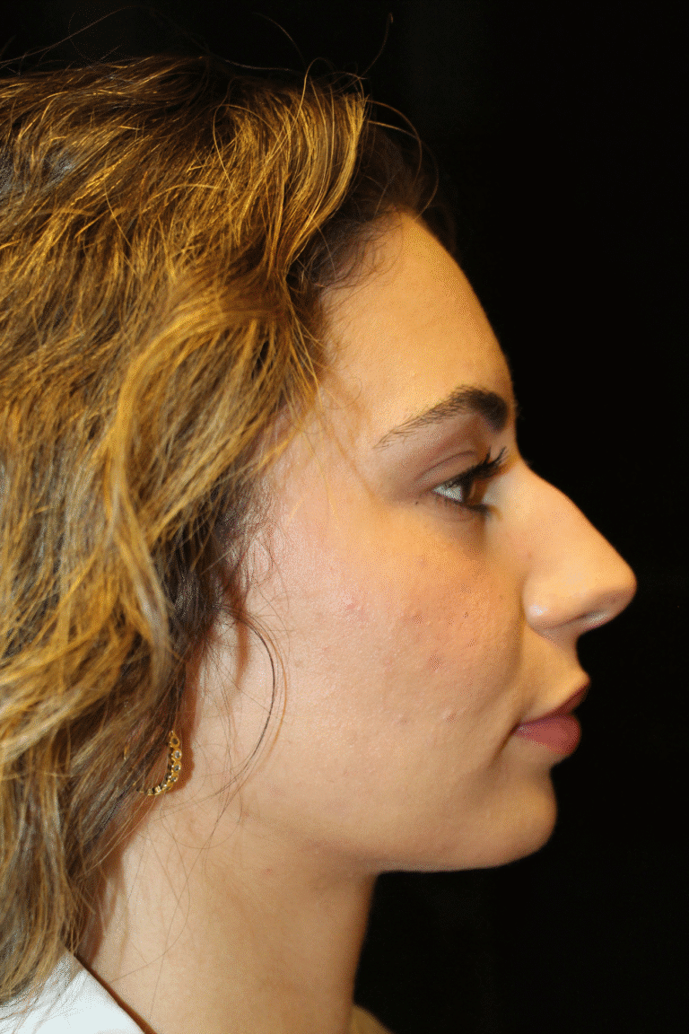 Before Image: Preservation Rhinoplasty - right-side