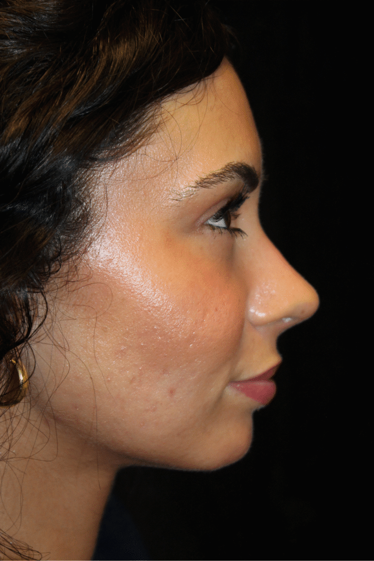 After Image: Preservation Rhinoplasty - right-side
