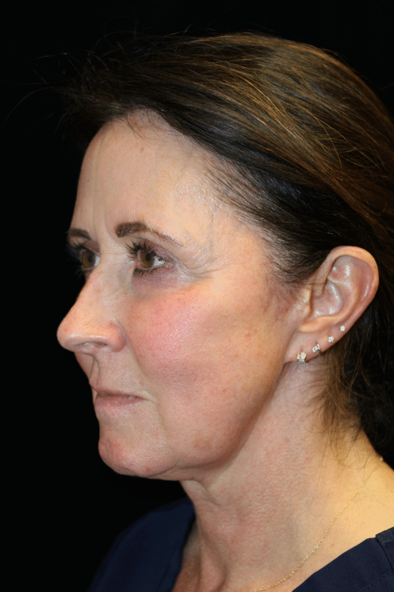 Before Image: Deep Plane Face & Neck Lift - left-front-oblique