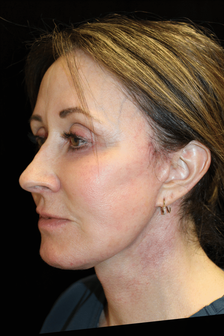 After Image: Deep Plane Face & Neck Lift - left-front-oblique