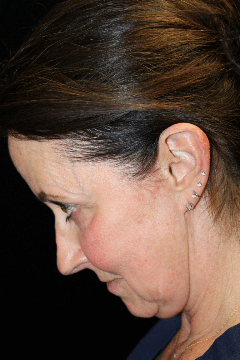 Before Image: Deep Plane Face & Neck Lift - left-side